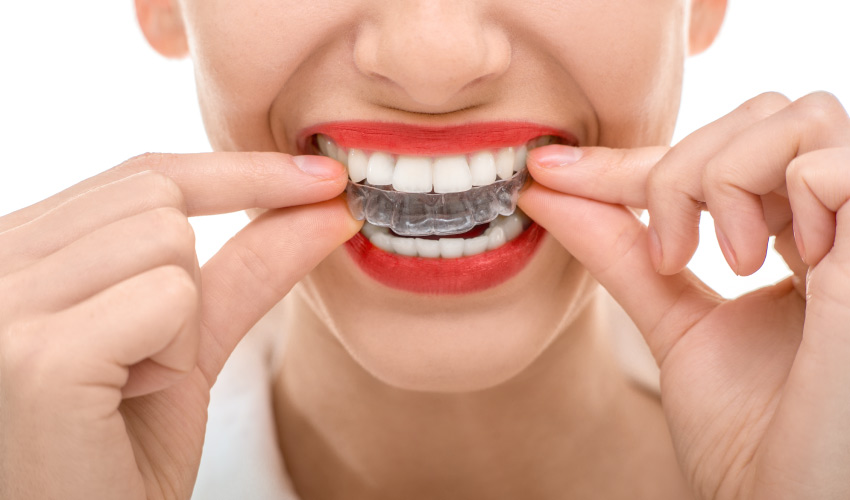 Closeup of a woman with red lipstick and clear aligners to straighten her teeth at True Dental in Odenton, MD