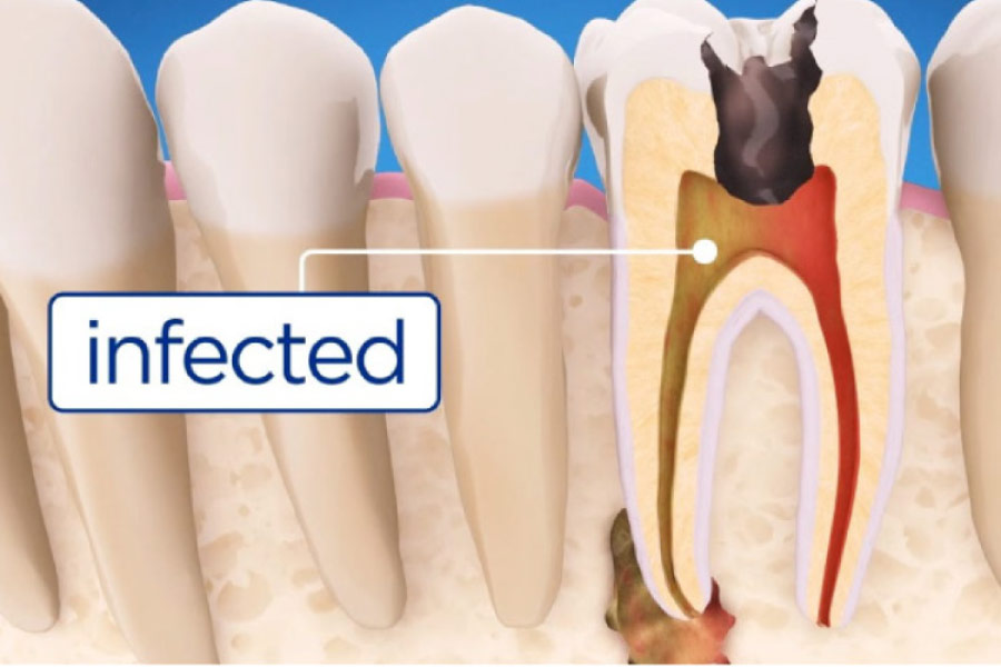 tooth that needs root canal