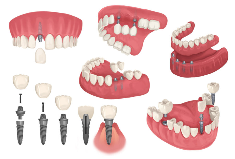 Illustration of different configurations of dental implants to replace missing teeth