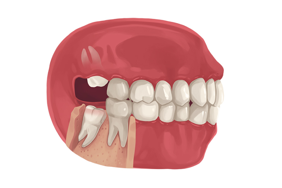 Model of a mouth showing wisdom teeth emerging at bad angles.