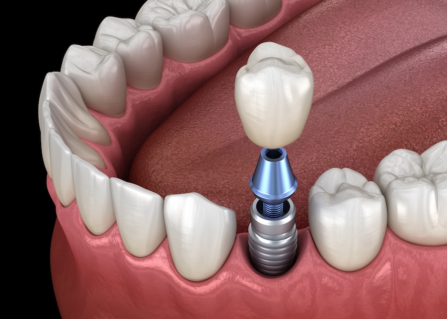 dental implants, implant health, jawbone density, implant-supported dentures, True Dental, Odenton MD, implant cost, dental implant maintenance