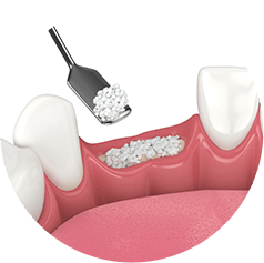 illustration of a bone graft
